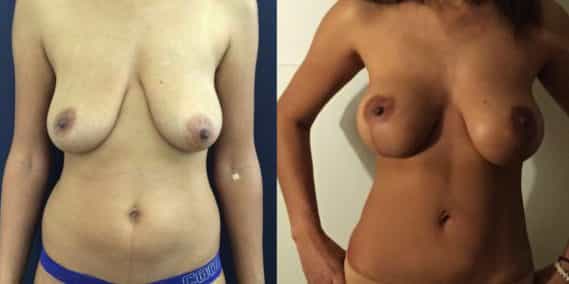 Breast Lift Colombia - Premium Care Plastic Surgery