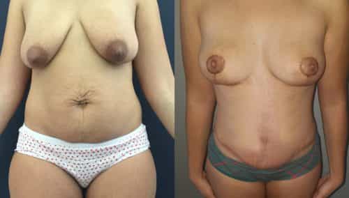 Breast Lift Colombia - Premium Care Plastic Surgery