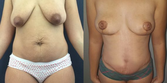Breast Lift Colombia - Premium Care Plastic Surgery