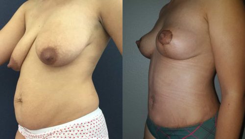 Breast Lift Colombia - Premium Care Plastic Surgery