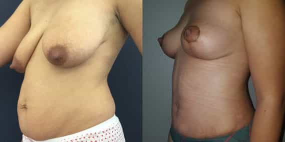 Breast Lift Colombia - Premium Care Plastic Surgery