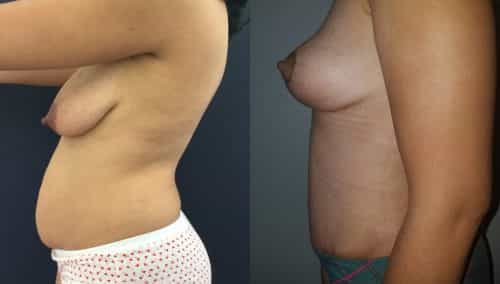 Breast Lift Colombia - Premium Care Plastic Surgery