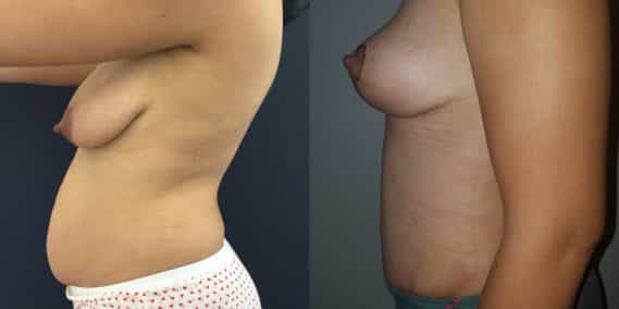Breast Lift Colombia - Premium Care Plastic Surgery