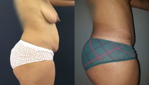 Breast Lift Colombia - Premium Care Plastic Surgery