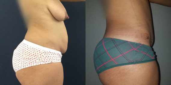 Breast Lift Colombia - Premium Care Plastic Surgery