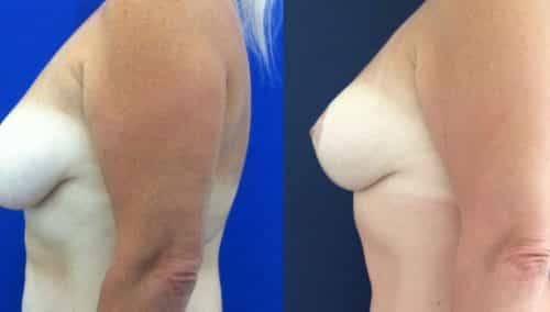 Breast Lift Colombia - Premium Care Plastic Surgery