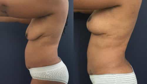 Breast Lift Colombia - Premium Care Plastic Surgery