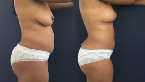 Breast Lift Colombia - Premium Care Plastic Surgery