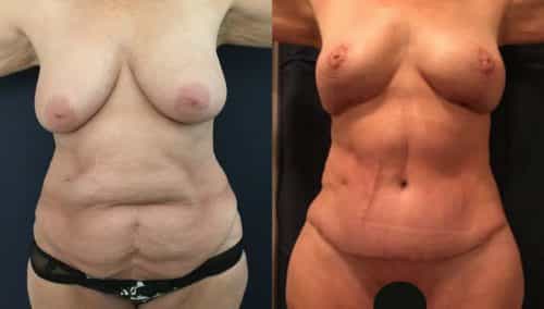Breast Lift Colombia - Premium Care Plastic Surgery