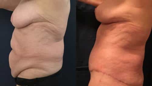 Breast Lift Colombia - Premium Care Plastic Surgery