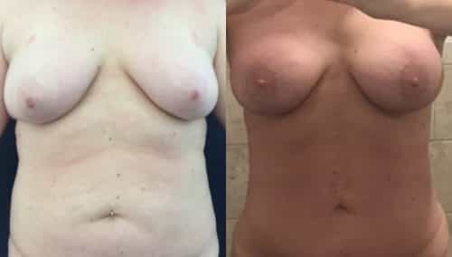 Breast Lift Colombia - Premium Care Plastic Surgery