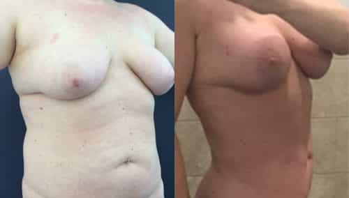 Breast Lift Colombia - Premium Care Plastic Surgery