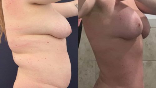 Breast Lift Colombia - Premium Care Plastic Surgery