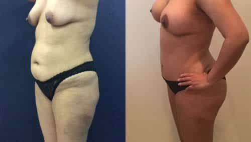 Breast Lift Colombia - Premium Care Plastic Surgery
