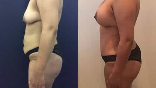 Breast Lift Colombia - Premium Care Plastic Surgery