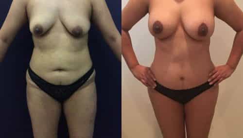 Breast Lift Colombia - Premium Care Plastic Surgery