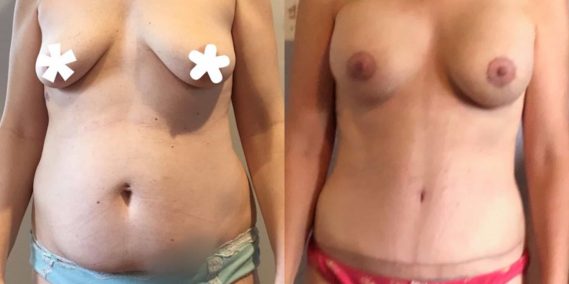 Breast Lift with Implants Colombia -Premium Care Plastic Surgery