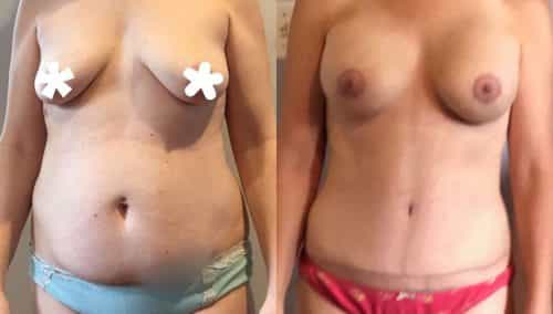 Breast Lift Colombia - Premium Care Plastic Surgery