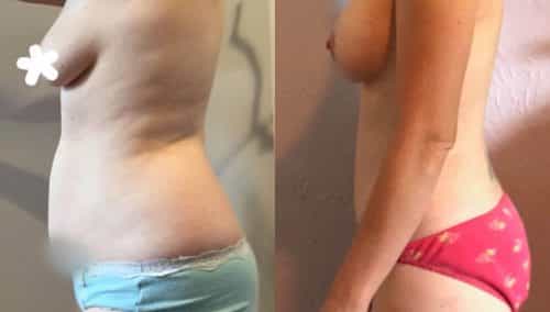 Breast Lift with Implants Colombia -Premium Care Plastic Surgery