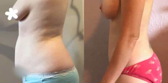 Breast Lift with Implants Colombia -Premium Care Plastic Surgery
