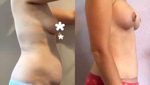 Breast Lift with Implants Colombia -Premium Care Plastic Surgery