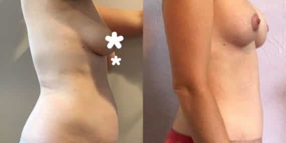 Breast Lift with Implants Colombia -Premium Care Plastic Surgery