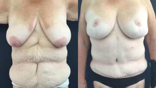 Breast Lift with Implants Colombia -Premium Care Plastic Surgery
