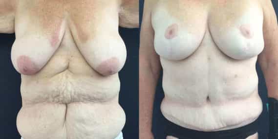 Breast Lift with Implants Colombia -Premium Care Plastic Surgery