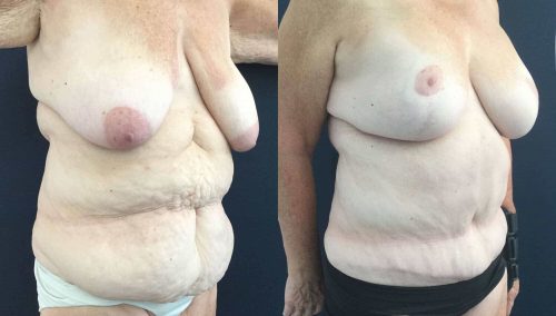 Breast Lift with Implants Colombia -Premium Care Plastic Surgery