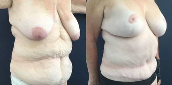 Breast Lift with Implants Colombia -Premium Care Plastic Surgery