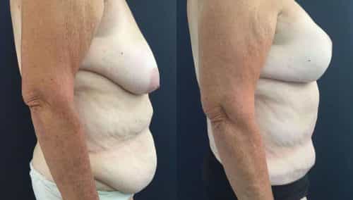 Breast Lift with Implants Colombia -Premium Care Plastic Surgery