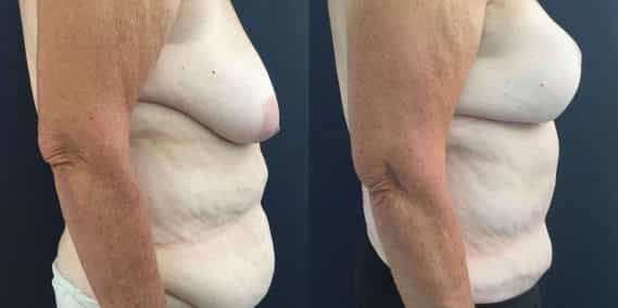 Breast Lift with Implants Colombia -Premium Care Plastic Surgery
