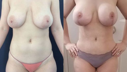 Breast Lift Colombia - Premium Care Plastic Surgery