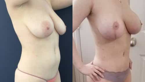 Breast Lift Colombia - Premium Care Plastic Surgery
