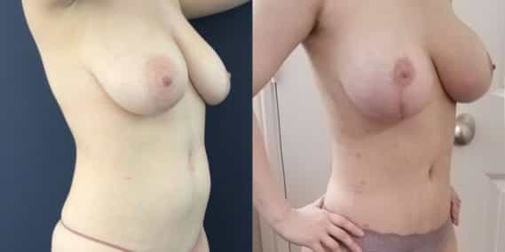 Breast Lift Colombia - Premium Care Plastic Surgery