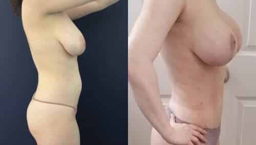 Breast Lift Augmentation Colombia - Premium Care Plastic Surgery