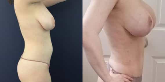 Breast Lift Augmentation Colombia - Premium Care Plastic Surgery