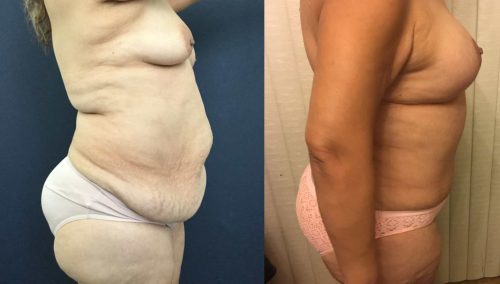 Breast Lift with Implants Colombia - Premium Care Plastic Surgery