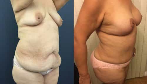 Breast Lift with Implants Colombia - Premium Care Plastic Surgery