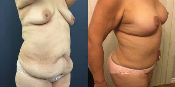 Breast Lift with Implants Colombia - Premium Care Plastic Surgery