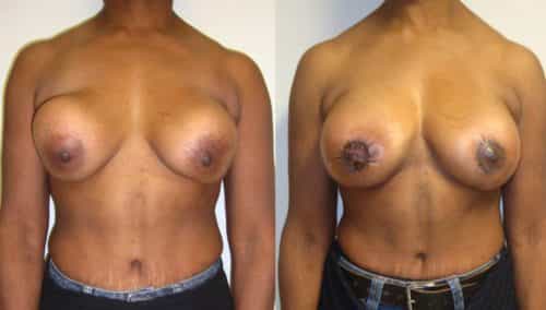 Before and after Breast Revision Colombia - Premium Care Plastic Surgery