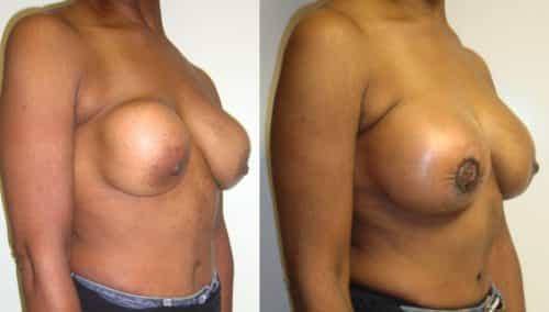 Before and after Breast Revision Colombia - Premium Care Plastic Surgery