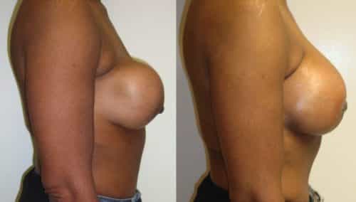 Before and after Breast Revision Colombia - Premium Care Plastic Surgery
