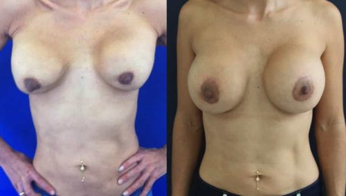Before and after Breast Revision Colombia - Premium Care Plastic Surgery