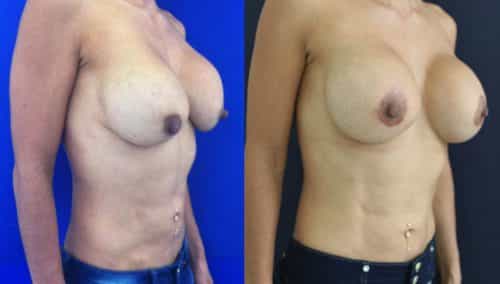 Before and after Breast Revision Colombia - Premium Care Plastic Surgery