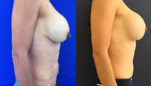 Before and after Breast Revision Colombia - Premium Care Plastic Surgery