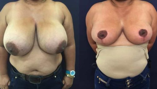 Breast Lift Colombia - Premium Care Plastic Surgery