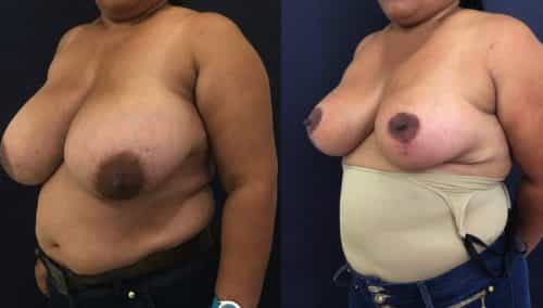 Breast Lift Colombia - Premium Care Plastic Surgery