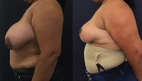 Breast Lift Colombia - Premium Care Plastic Surgery