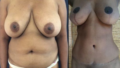 Breast Lift Colombia - Premium Care Plastic Surgery
